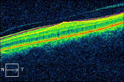 Macular cube B-scan